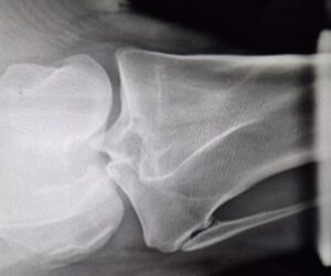 Radiografia della grassella, proiezione postero-anteriore